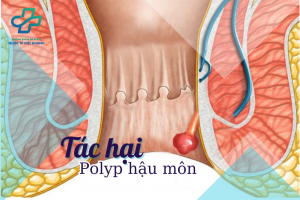 [Top 6+] Tác hại của bệnh polyp hậu môn chớ nên coi thường 