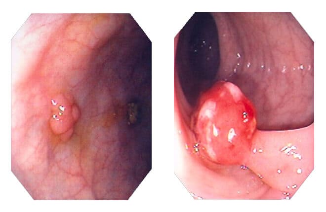 Cách chữa polyp hậu môn trực tràng