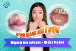 Bệnh giang mai ở miệng: Nguyên nhân, dấu hiệu và phương pháp